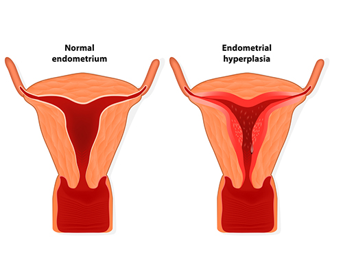 Как ендометриозата пречи да забременея?